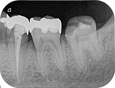 本日の根管治療 サーマフィルによる根管充填｜広島市南区の自由診療