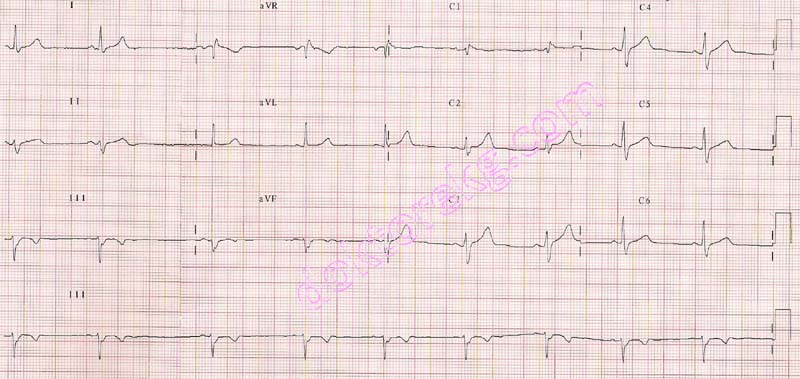 old inferior myocardial infarction - electrocardiography (ecg