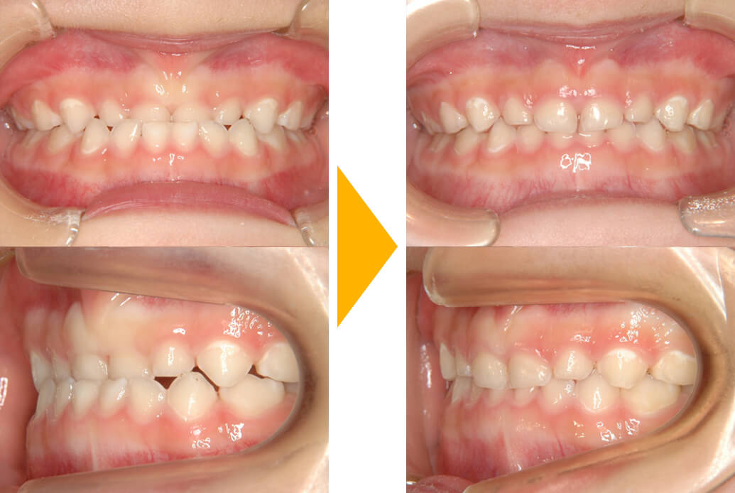乳歯列期の矯正治療｜茨木市の歯医者（歯科医院）「みやの矯正・小児