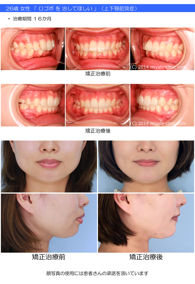 症例の一覧 - 気づかれない目立たない矯正／みやび矯正歯科医院 - 岡山