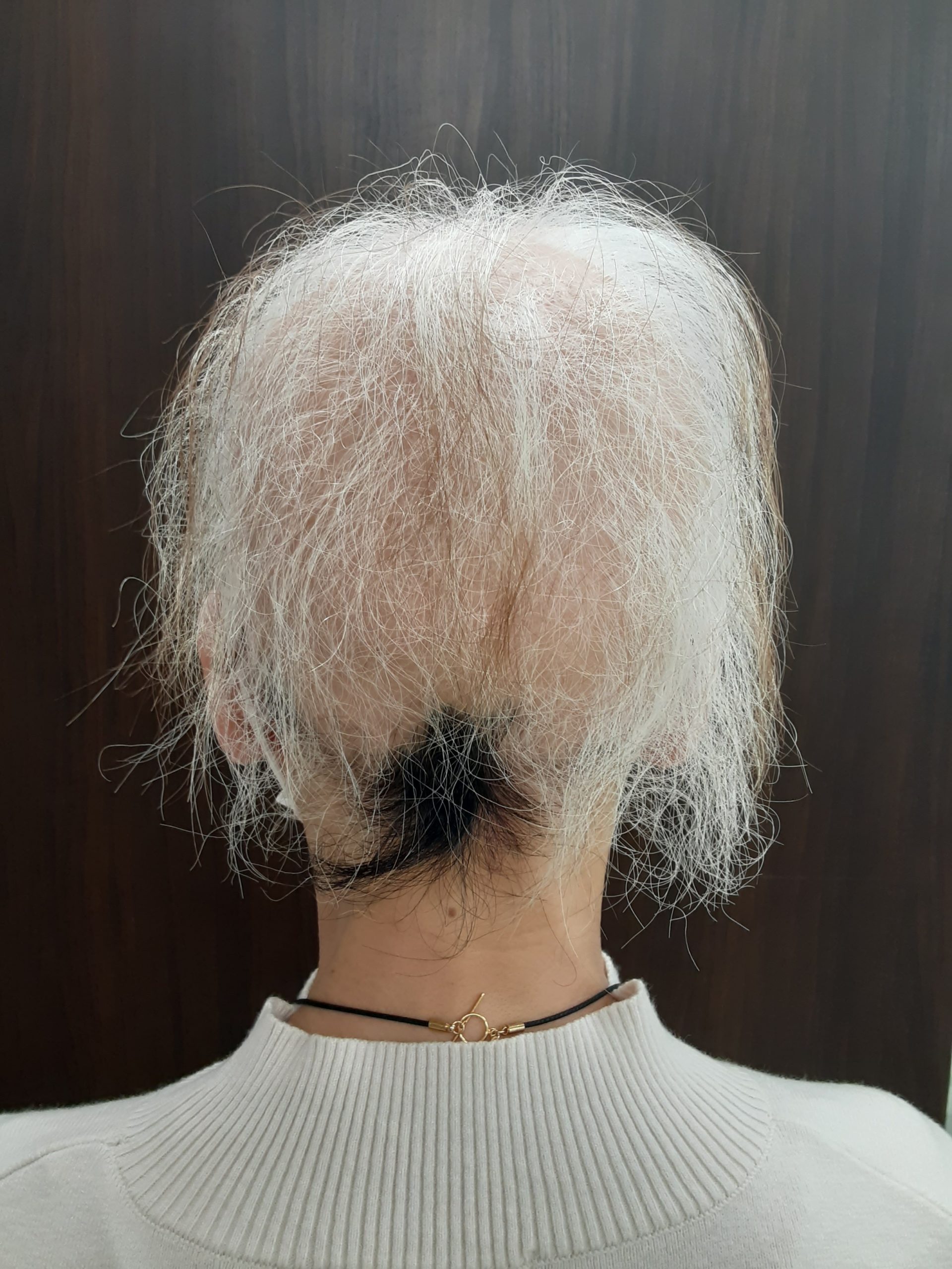 自費 AGA クリニックの治療無効でも治った全身性脱毛症 - 症例紹介