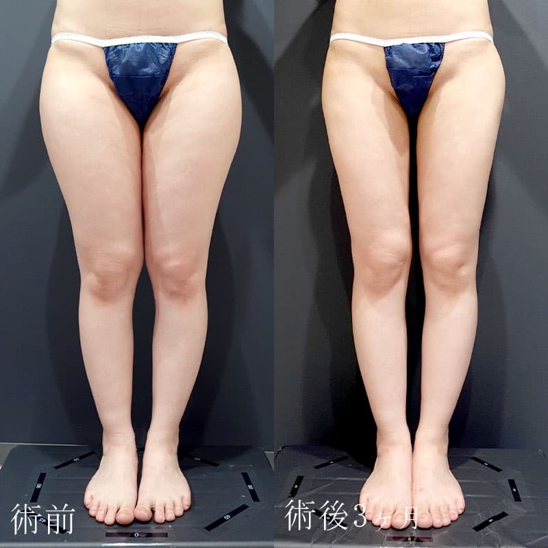 太ももの脂肪吸引の症例写真・ビフォーアフター Ι 執刀医：鈴木 凛