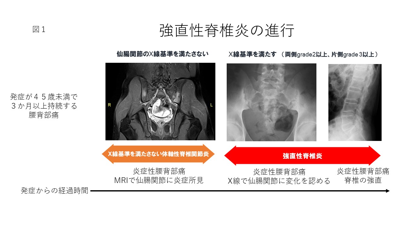 強直性脊椎炎（指定難病271） – 難病情報センター