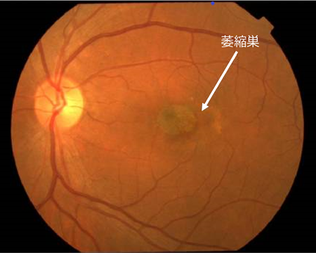 加齢黄斑変性｜日本眼科学会による病気の解説