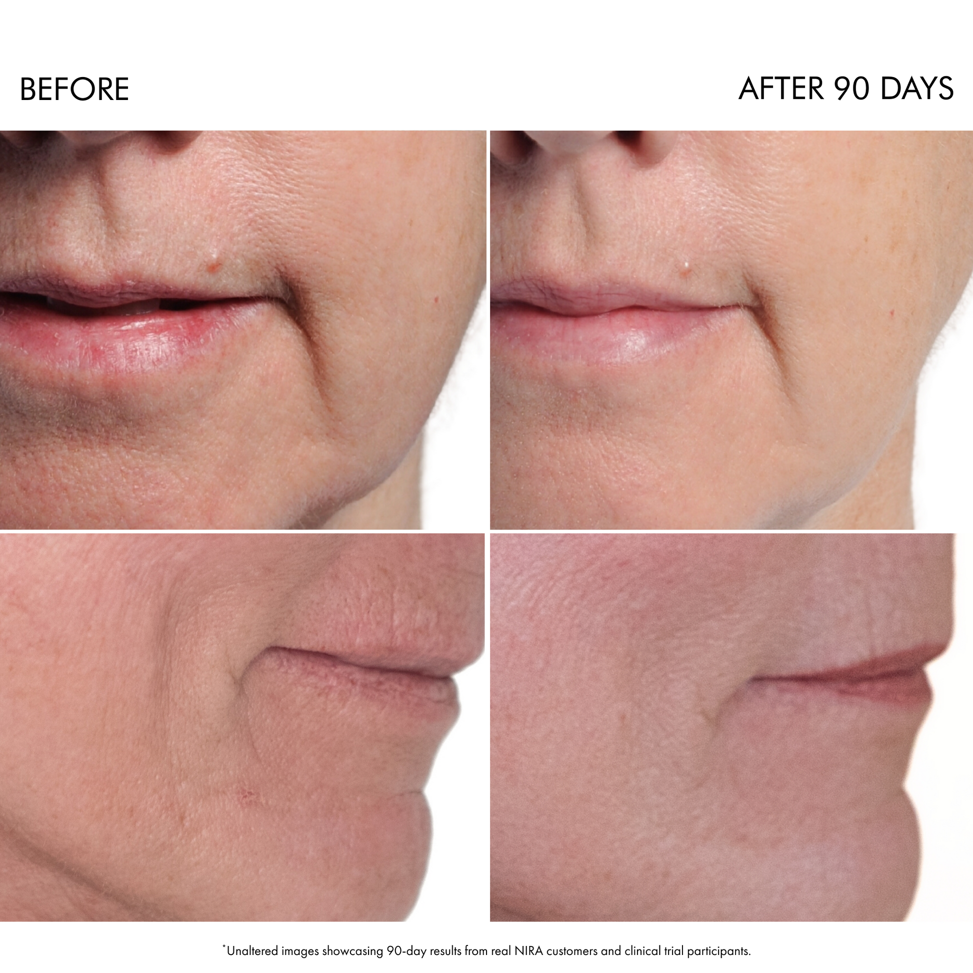 Home Skincare Laser for Under-Eye Wrinkles | NIRA Precision Laser