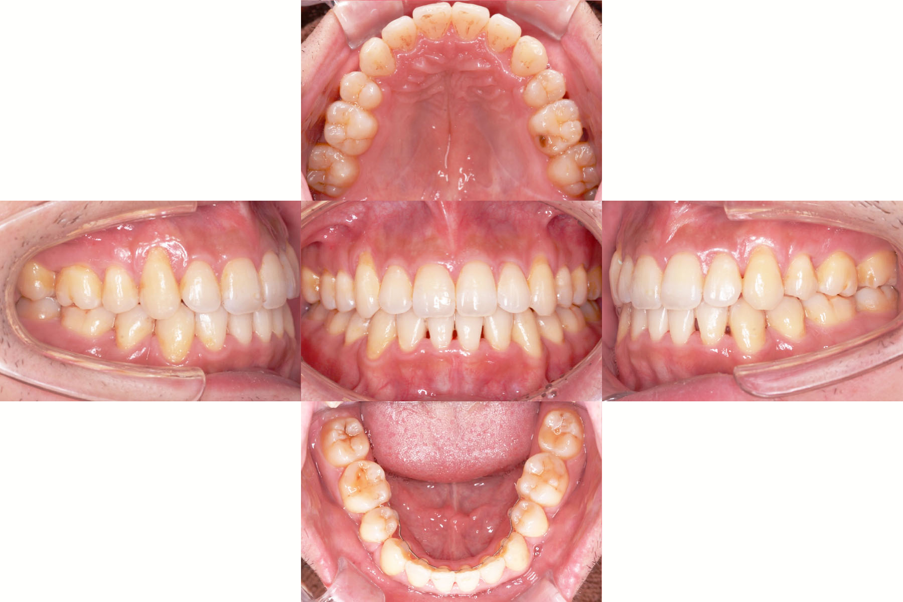 矯正歯科｜西小山の歯医者｜西小山駅たけうち歯科・矯正歯科