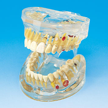 疾患説明用透明顎模型 [PE-TDS001(P12P-100M)]｜株式会社ニッシン