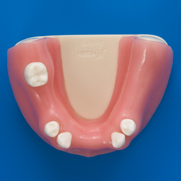 インプラント基礎実習用顎模型 [P9-X.1033]｜株式会社ニッシン｜歯科