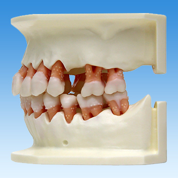 歯周病学基礎実習用顎模型(歯槽歯肉ピンク色・D咬合器つき) [PER1032