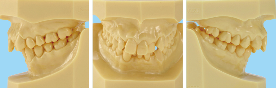 1色レジン製不正咬合顎模型 [D1-O各種](咬合器なし)｜株式会社ニッシン