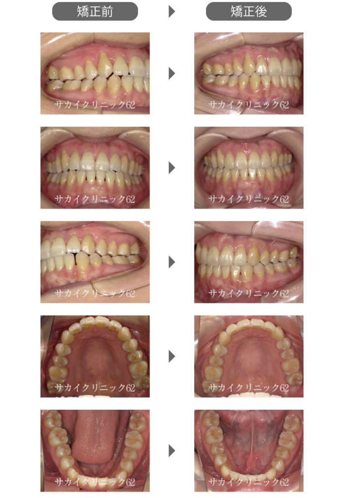 矯正歯科～成人・小児・部分矯正～ | sakai-clinic62