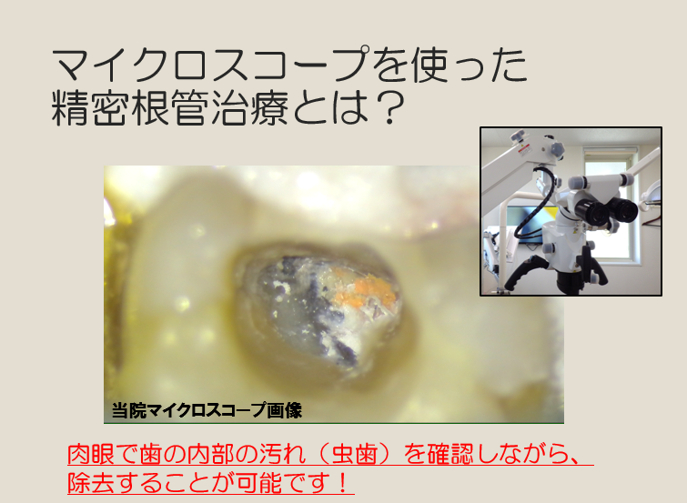 マイクロスコープを使った精密根管治療 – 医療法人 杏済会 坂詰歯科