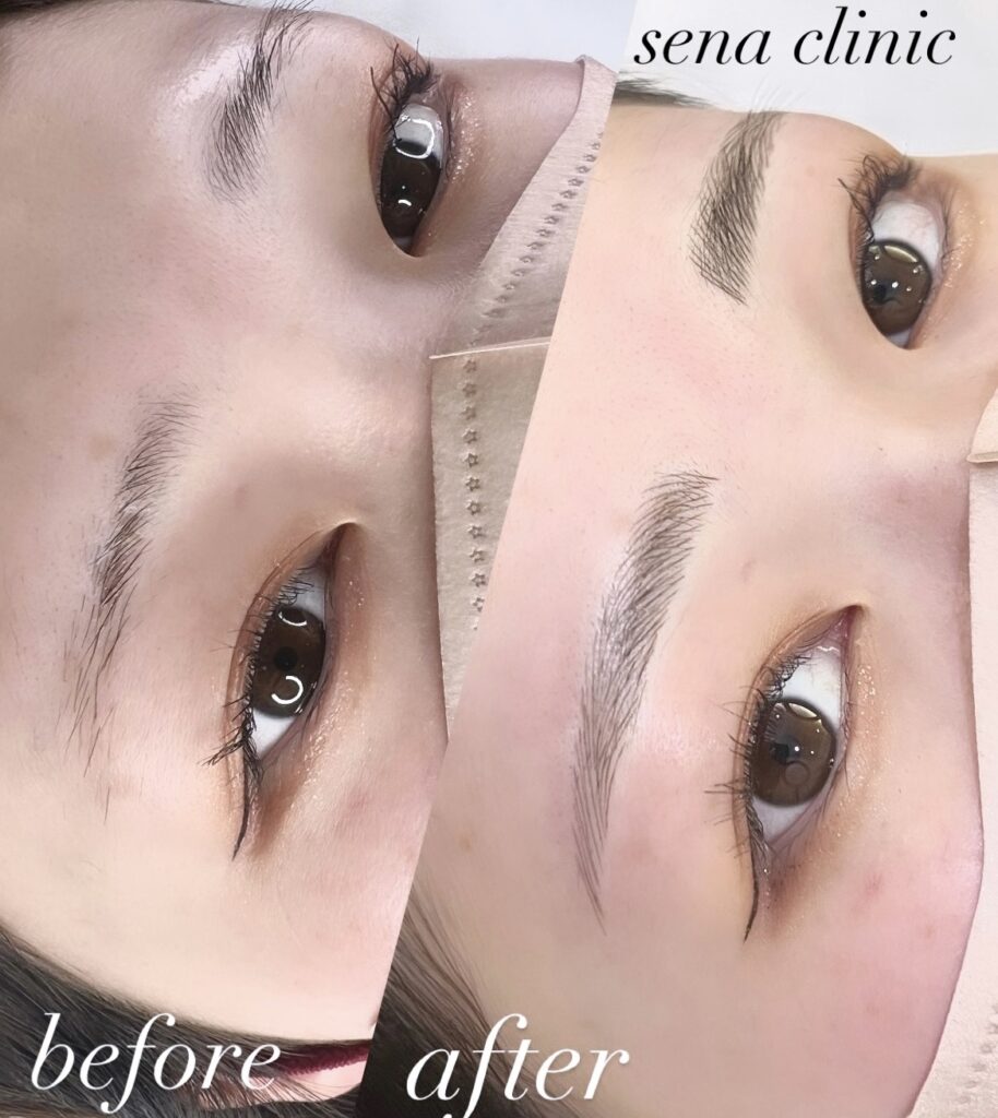アートメイク – セナ クリニック