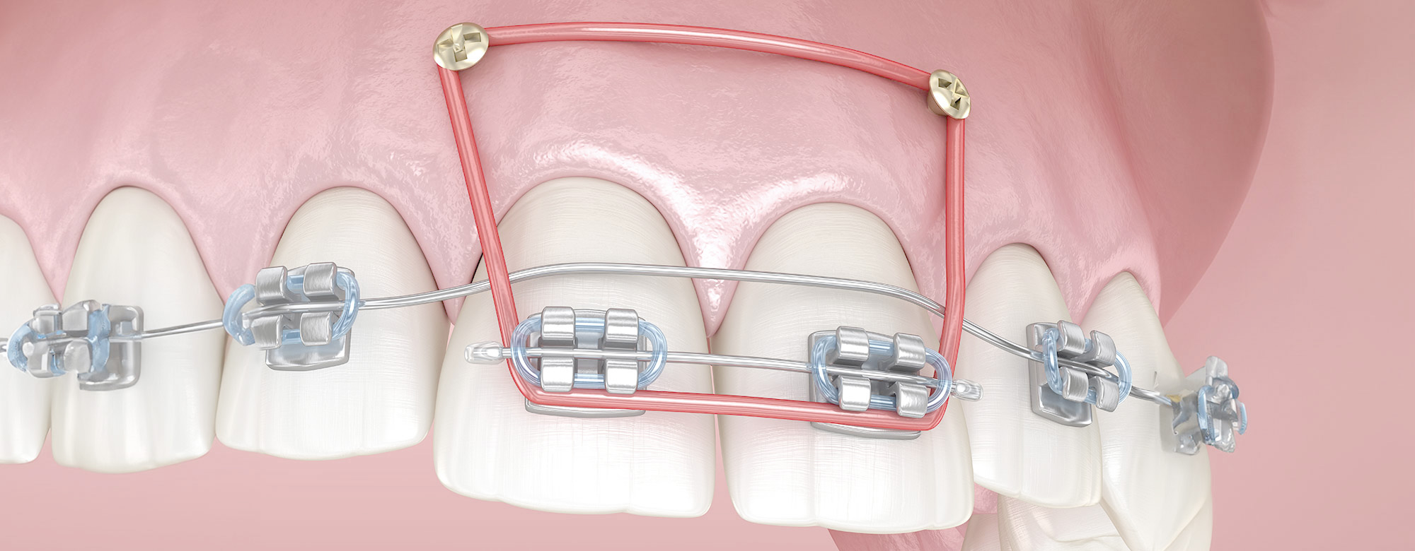 歯科矯正用アンカースクリューを用いた矯正歯科治療｜仙台の矯正 仙台