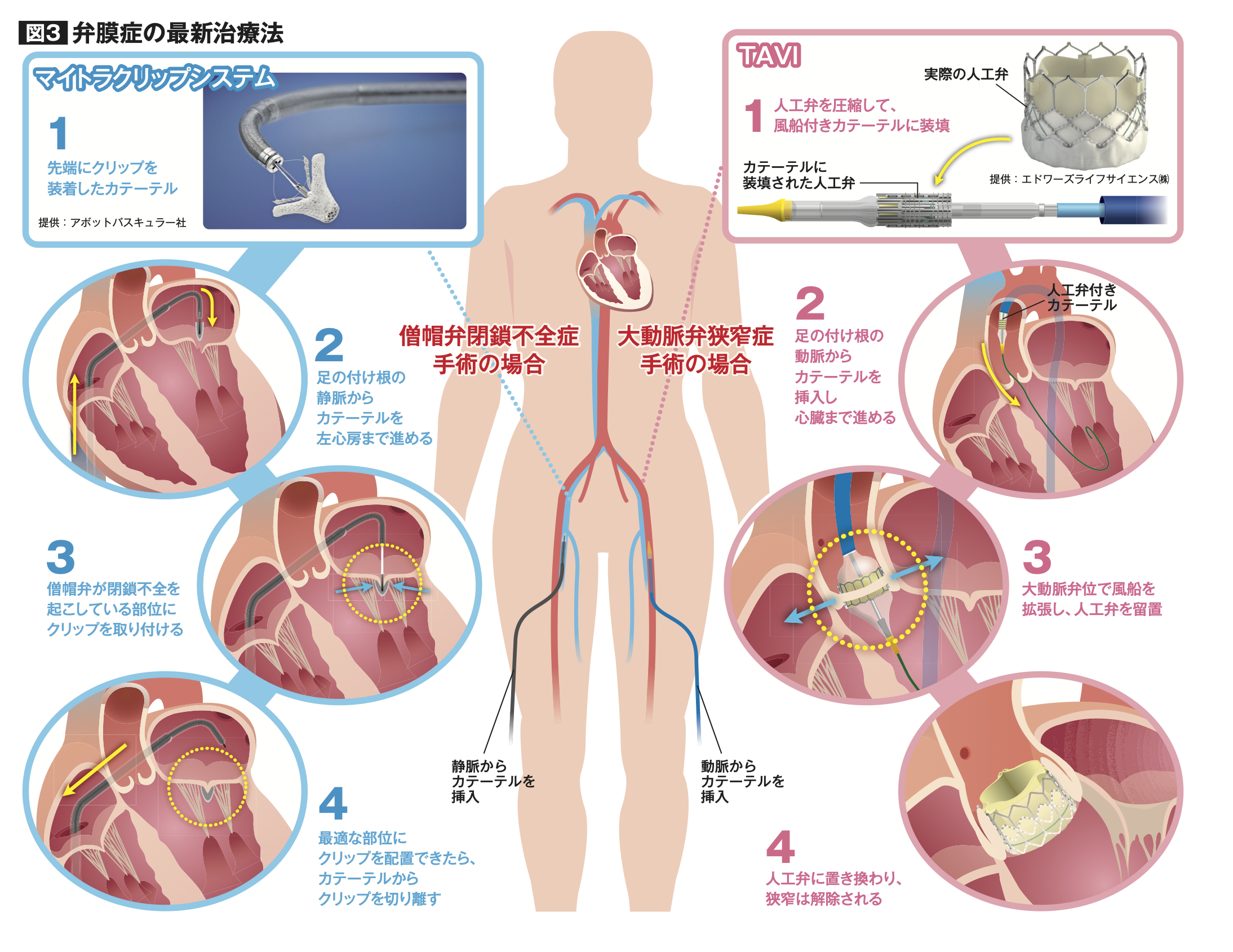 弁膜症の危険性と最新カテーテル治療 | 循環器内科 | 仙台厚生病院