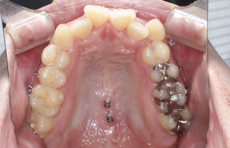 アンカースクリューを使った歯科矯正方法とは？？ - 渋谷矯正歯科
