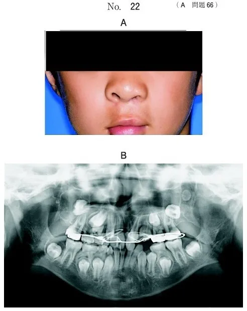 歯科医師国家試験 第113回 A66問題 | 歯科国試ドットコム