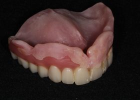 義歯（入れ歯） – 市原市の歯医者 インプラント・マイクロスコープ