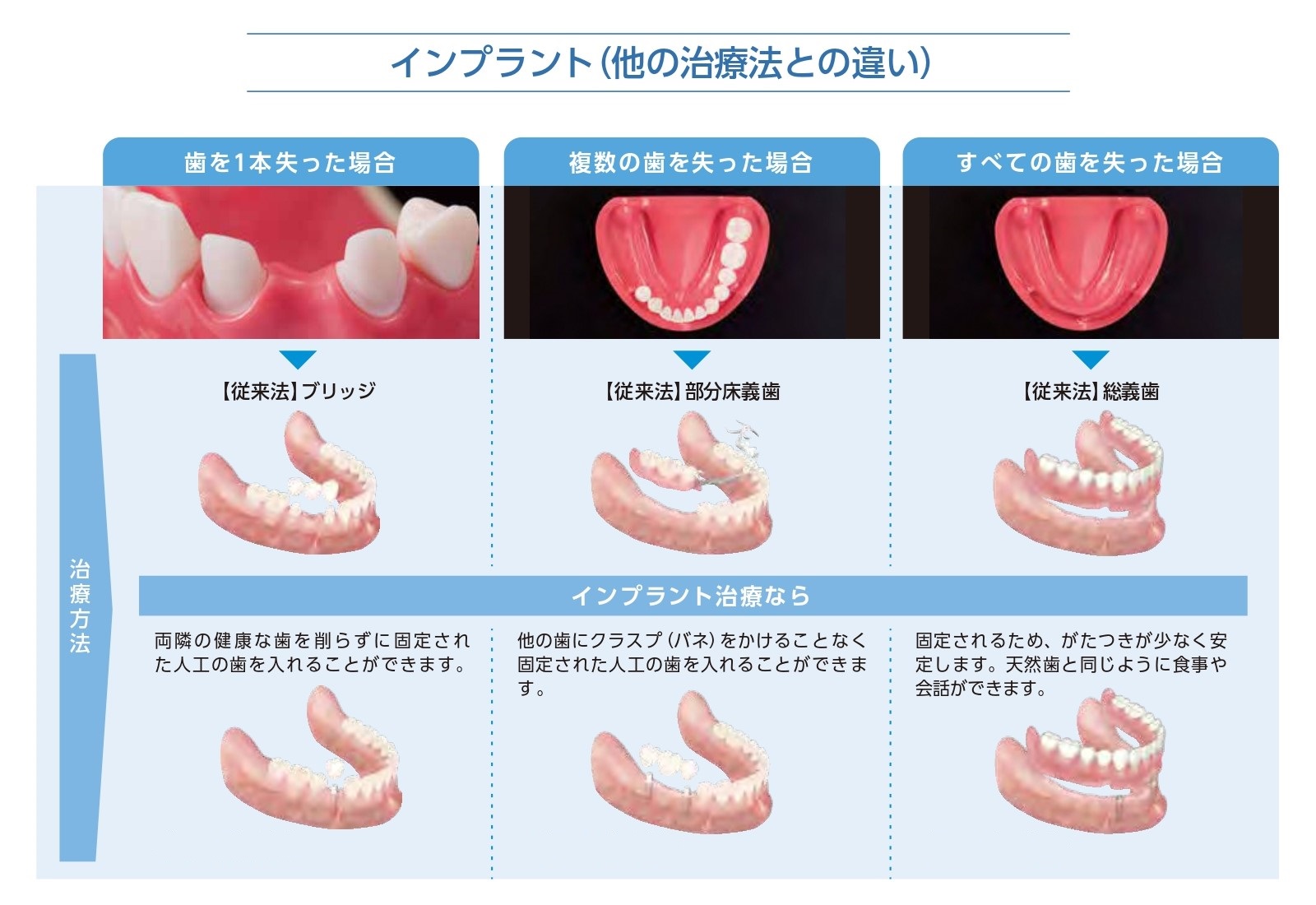 インプラント｜ベルク鶴ヶ丘店に隣接の歯医者さん「しのはら歯科医院」