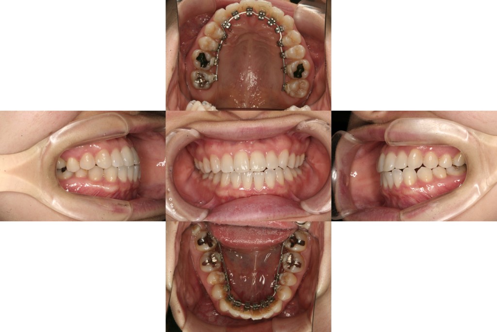 軽度の反対咬合を治したい | 新宿歯科・矯正歯科