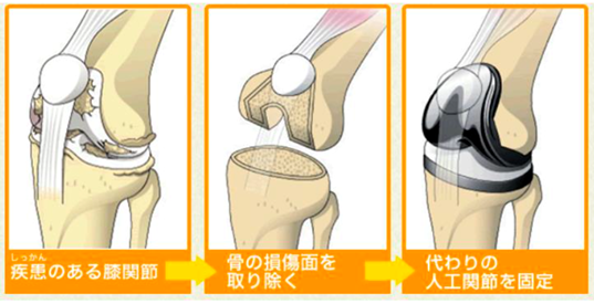 人工膝関節 | 四肢関節再建センター | 診療科案内 | 診療科・部門案内