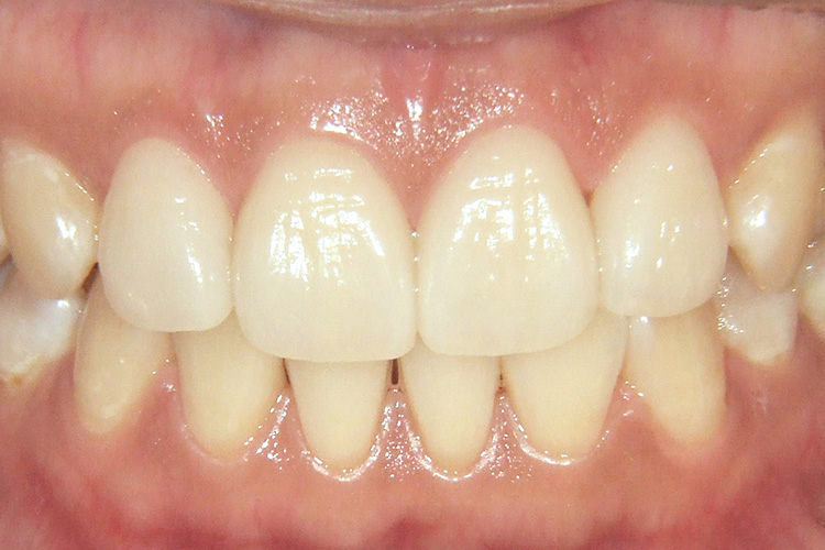 ラミネートベニアによる前歯のすきっ歯治療（審美歯科） | 歯を守って