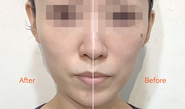 高崎・太田の医療用ハイフ（HIFU）｜群馬県高崎・太田の美容皮膚科