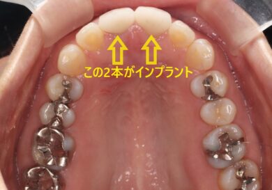 インプラントと矯正はどっちが先？併用することはできる？どちらも受け