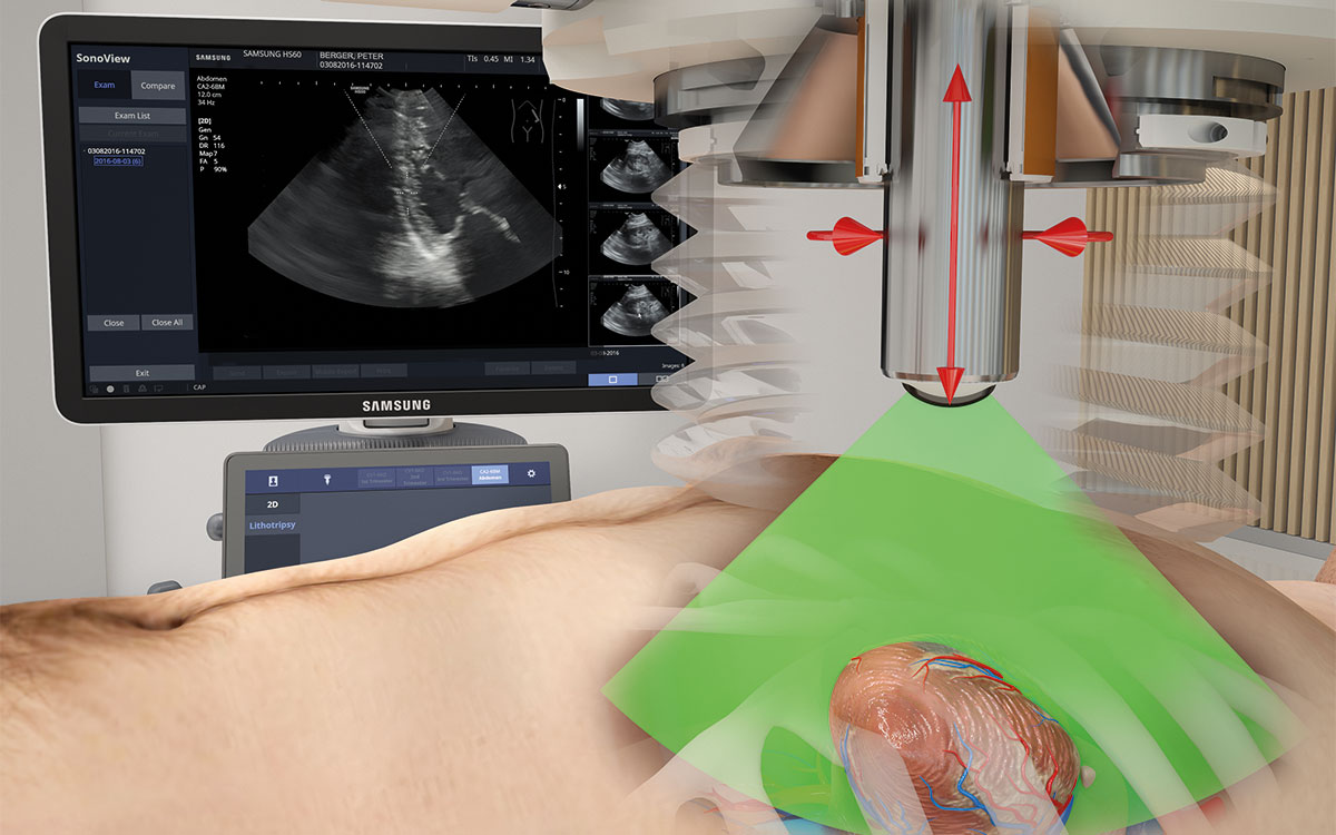 MODULITH SLC – Cardiac Shockwave Therapy (CSWT) for Angina
