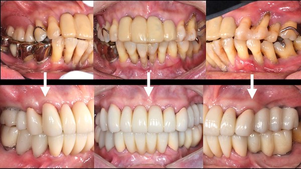 症例】歯周病に対するインプラント治療｜港南台パーク歯科クリニック