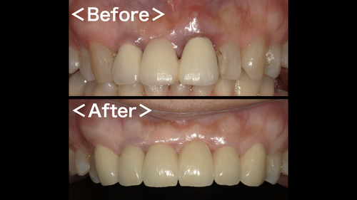 症例】ジルコニアセラミックブリッジによる前歯の審美治療｜港南台の