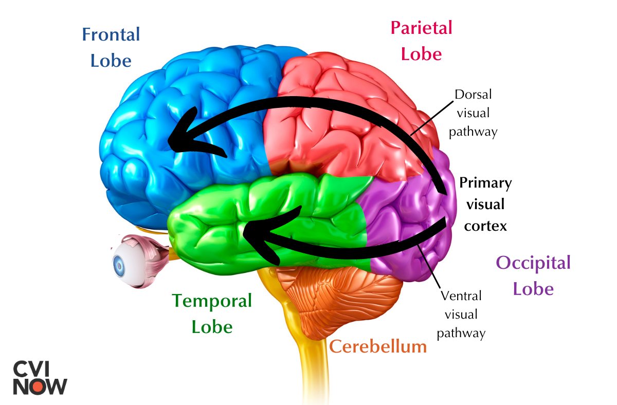 Higher-order visual pathways and the CVI brain – Perkins School
