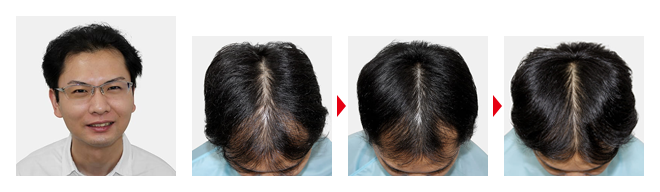 抜け毛の原因を知りたい！正常or病的な抜け毛の見分け方、対処法を解説