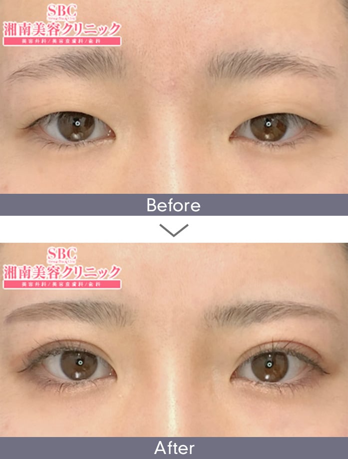 週末二重®｜二重・目元整形なら湘南美容クリニック【公式】