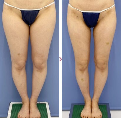 太ももの脂肪吸引｜脂肪吸引なら湘南美容クリニック【公式】