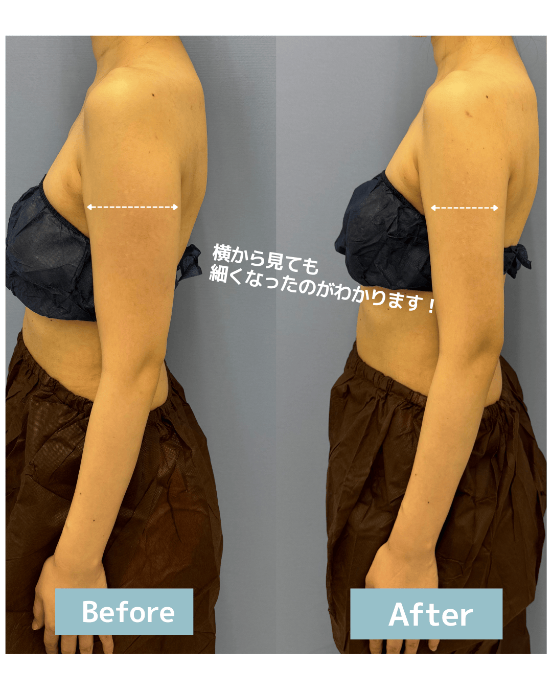 ダウンタイムを抑えたい方へ！脂肪吸引注射の新メニューとは？最新機器