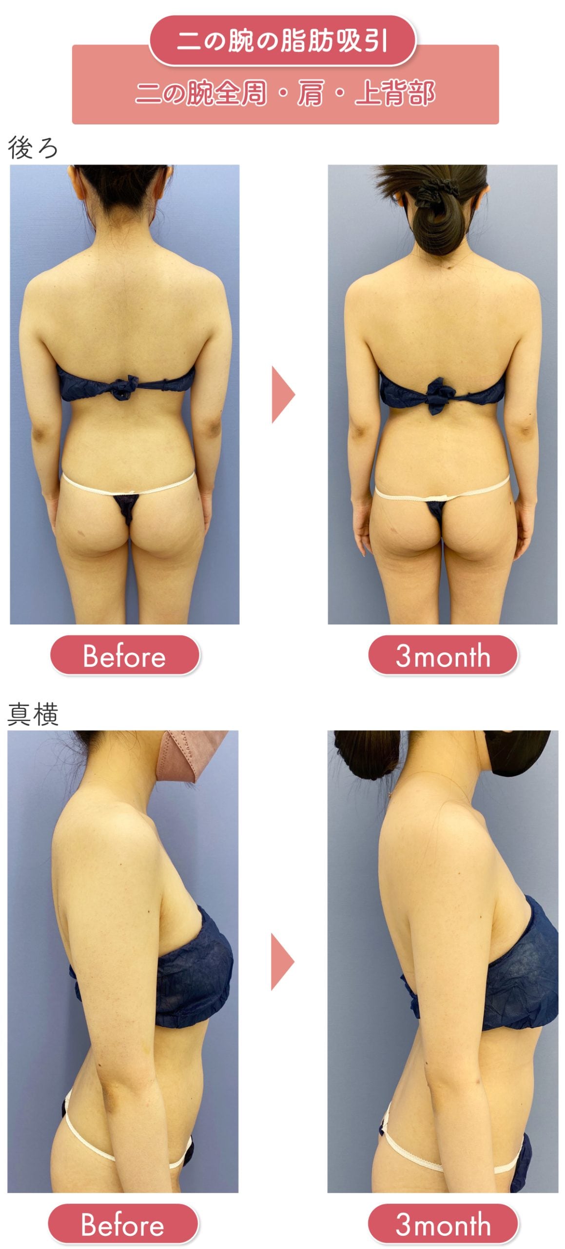 脂肪吸引の名医といえばSBC銀座院・葛島医師！症例を部位別に紹介