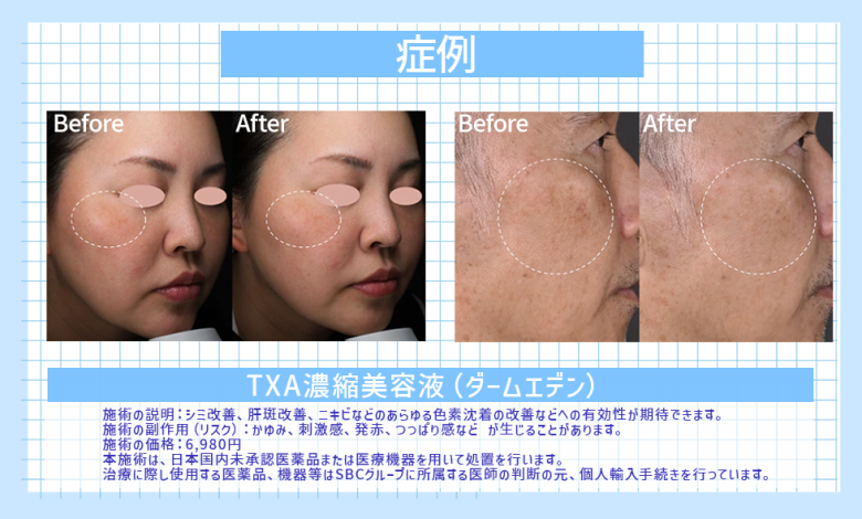 シミや肝斑がない美白美肌へ✨お家の美白ケアはTXA濃縮美容液