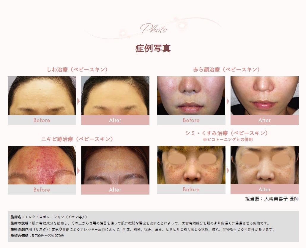 美肌への近道！】湘南美容クリニックのエレクトロポレーション（イオン