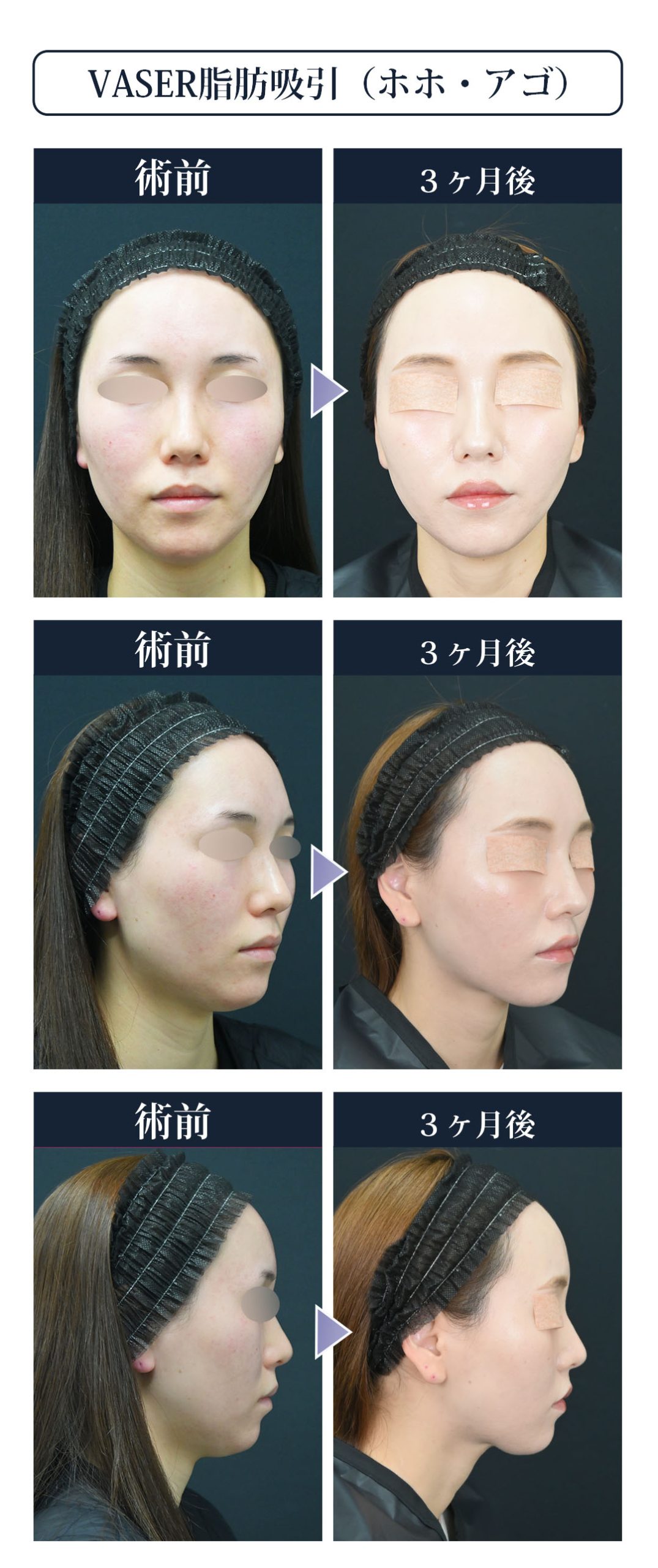 顔の脂肪吸引の名医といえば湘南美容外科名古屋院の山本高士医師！症例