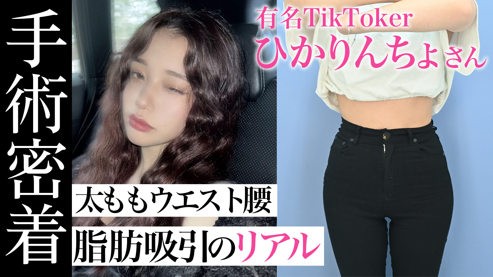 長年の下半身太り」大量の脂肪に感動！ひかりんちょさんの脂肪吸引に