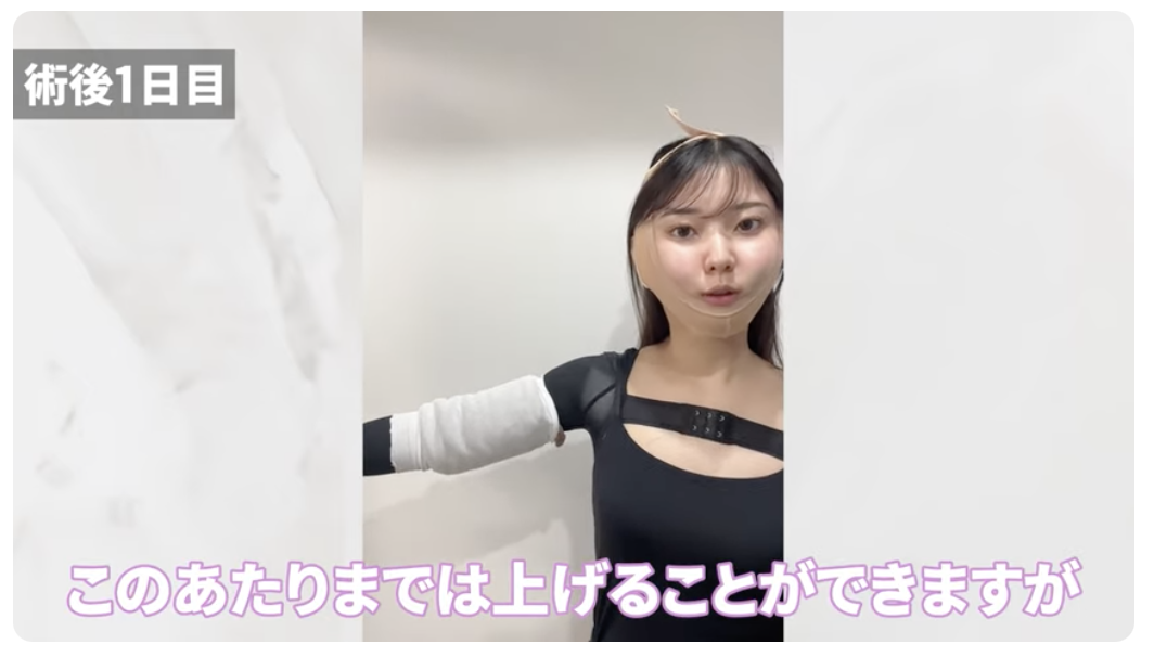 脂肪吸引ダウンタイム特集・二の腕編】後悔しない/ビフォーアフター