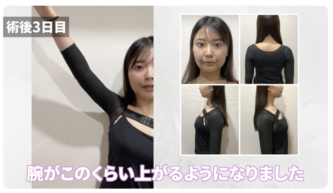 脂肪吸引ダウンタイム特集・二の腕編】後悔しない/ビフォーアフター