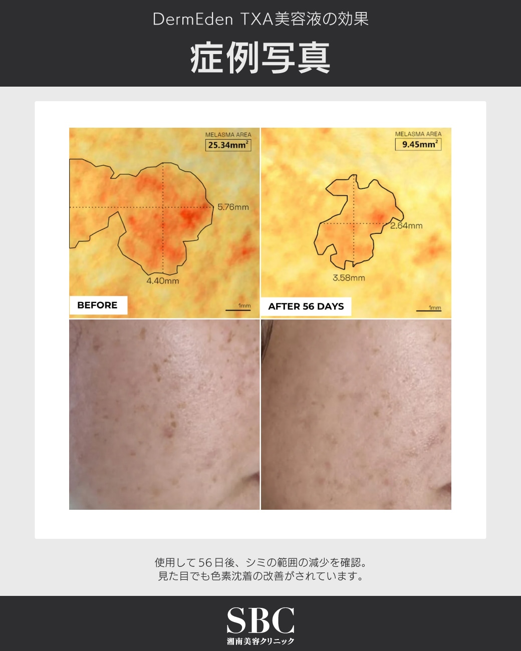 新治療】DermEden（ダームエデン）が豊洲院に登場！あらゆる種類のシミ