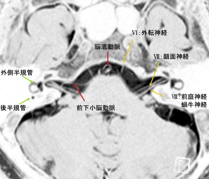 小脳橋角部の正常解剖 MRI CISS画像より | WEB脳神経外科