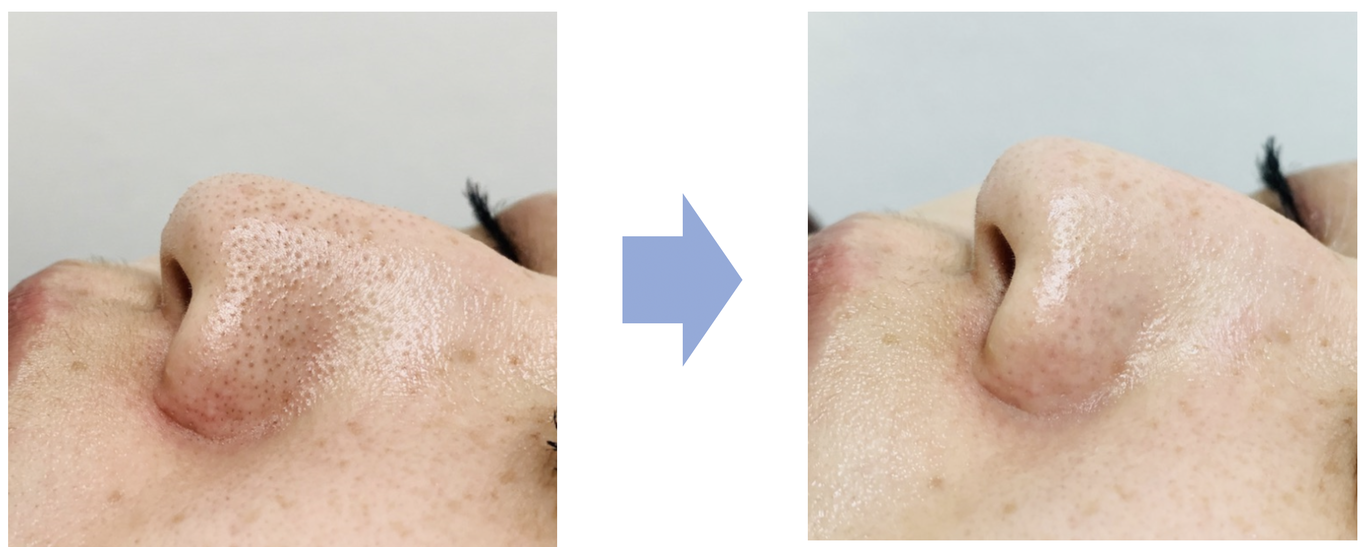 ハイドラジェントル ｜長野で美容皮膚科ならウェンデルクリニック