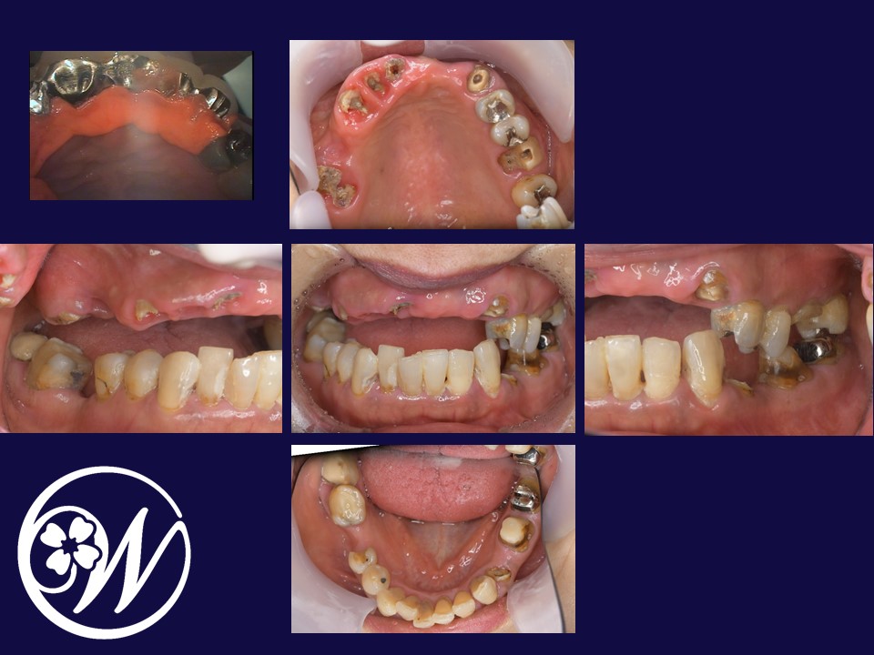 症例】【多数歯欠損をインプラント治療にてリカバリーした全顎症例