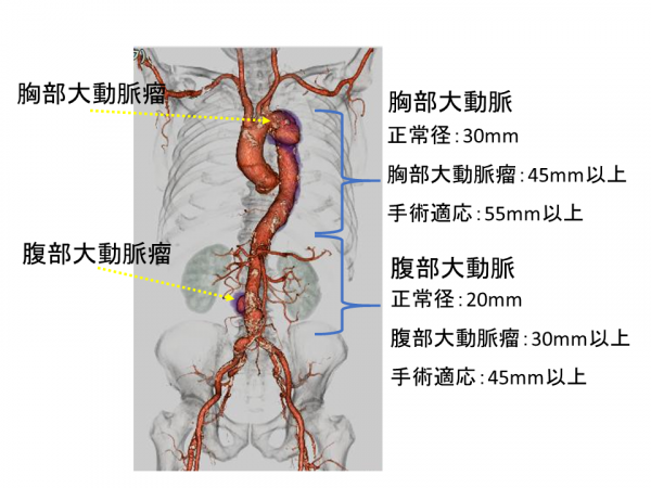 EVAR/TEVAR －ステントグラフト内挿術－｜徳島赤十字病院