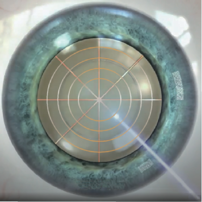 新時代の白内障手術システムPerfect Z-CATARACT System - 白内障手術