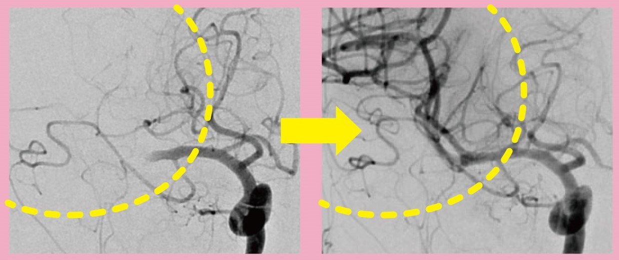 最新機器で進化する治療 脳血管内治療最前線 | 広報誌「高松日赤だより